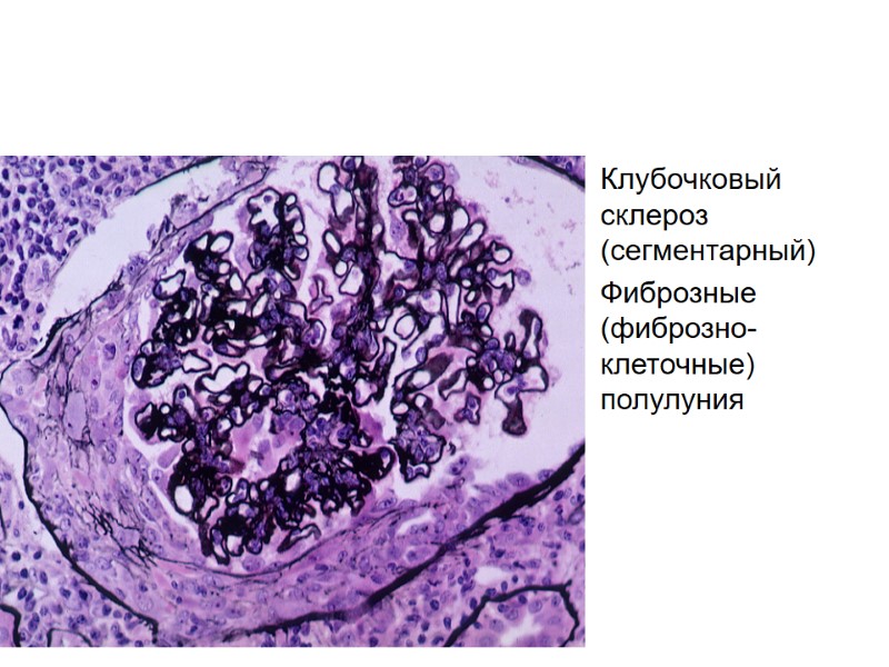 Клубочковый склероз (сегментарный) Фиброзные (фиброзно-клеточные) полулуния